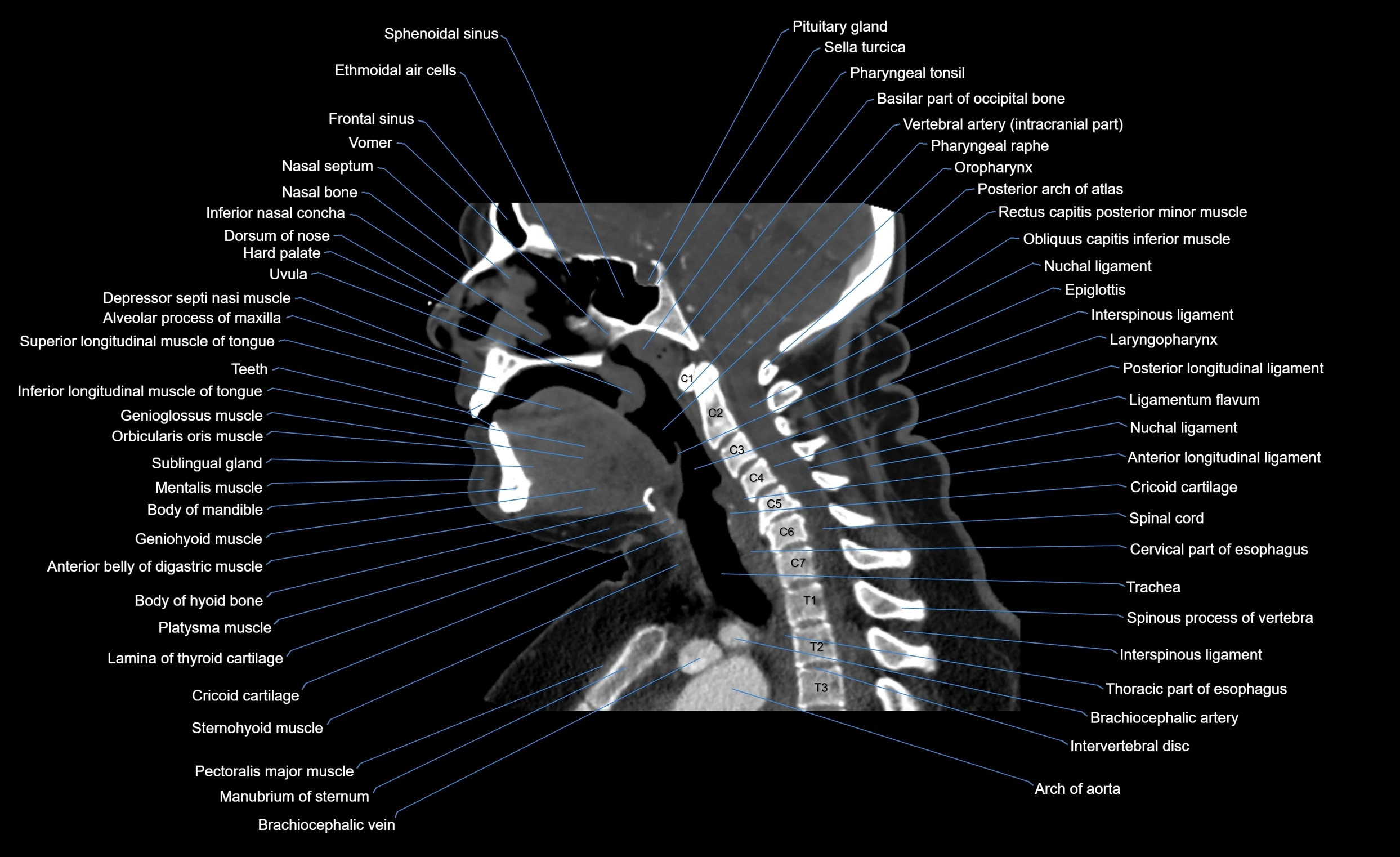Neck CT sagittal cross sectional anatomy 3D  radiology  image-img-00001-00002.webp
